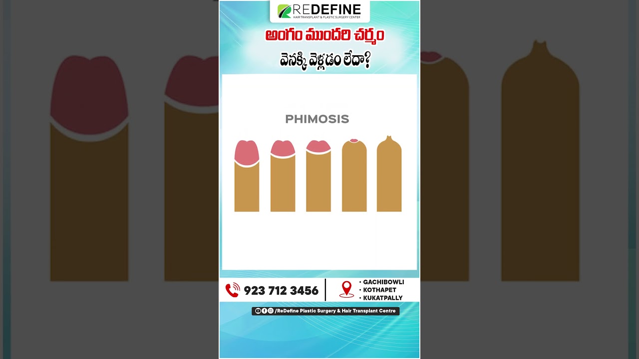 Best Treatment for Phimosis | Tight foreskin | ReDefine Channel #healthfacts #telugushorts #shorts