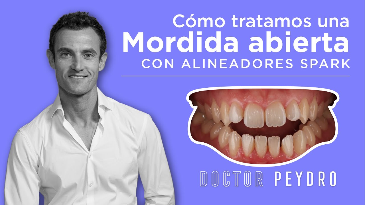 🦷 Cómo solucionar una mordida abierta con ortodoncia