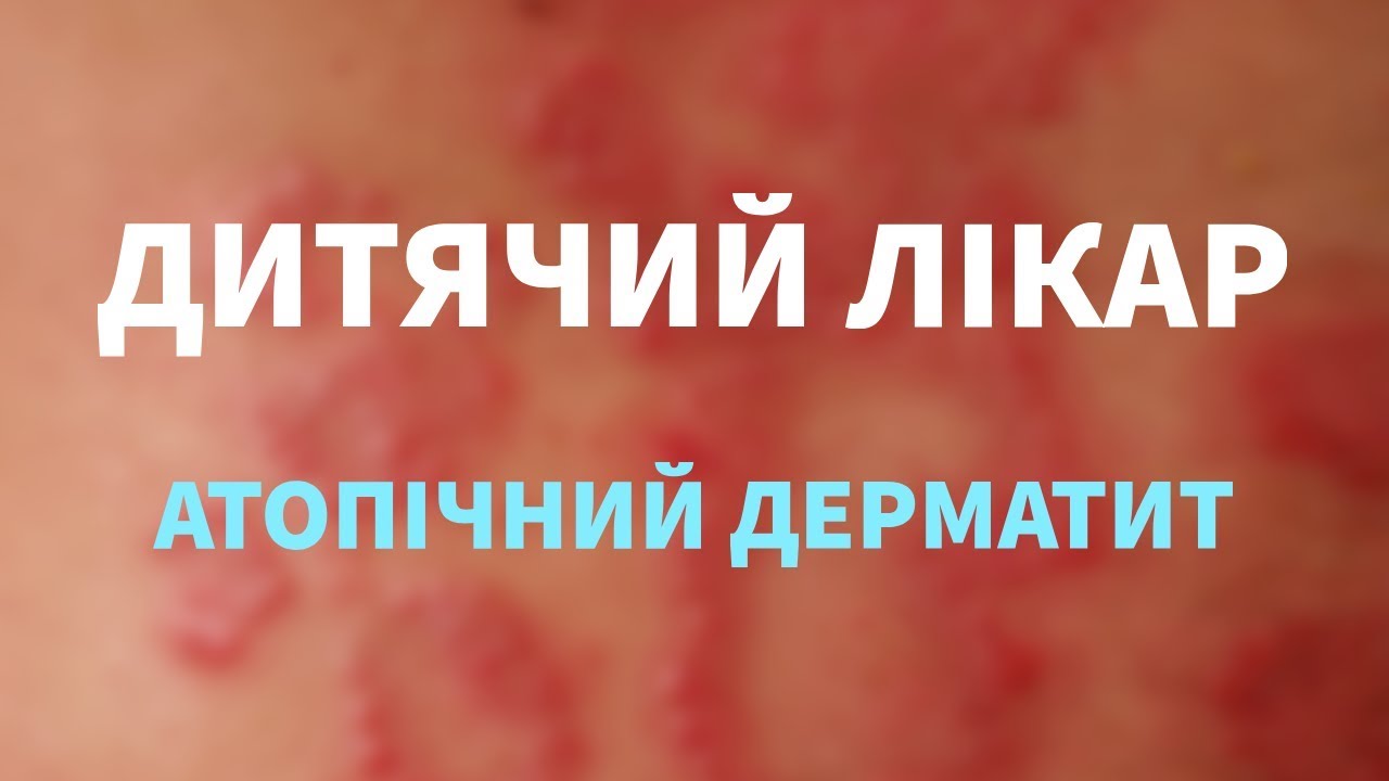 Атопічний дерматит! Що це? Як лікувати дерматит. Дитячий лікар. Дитячі хвороби.