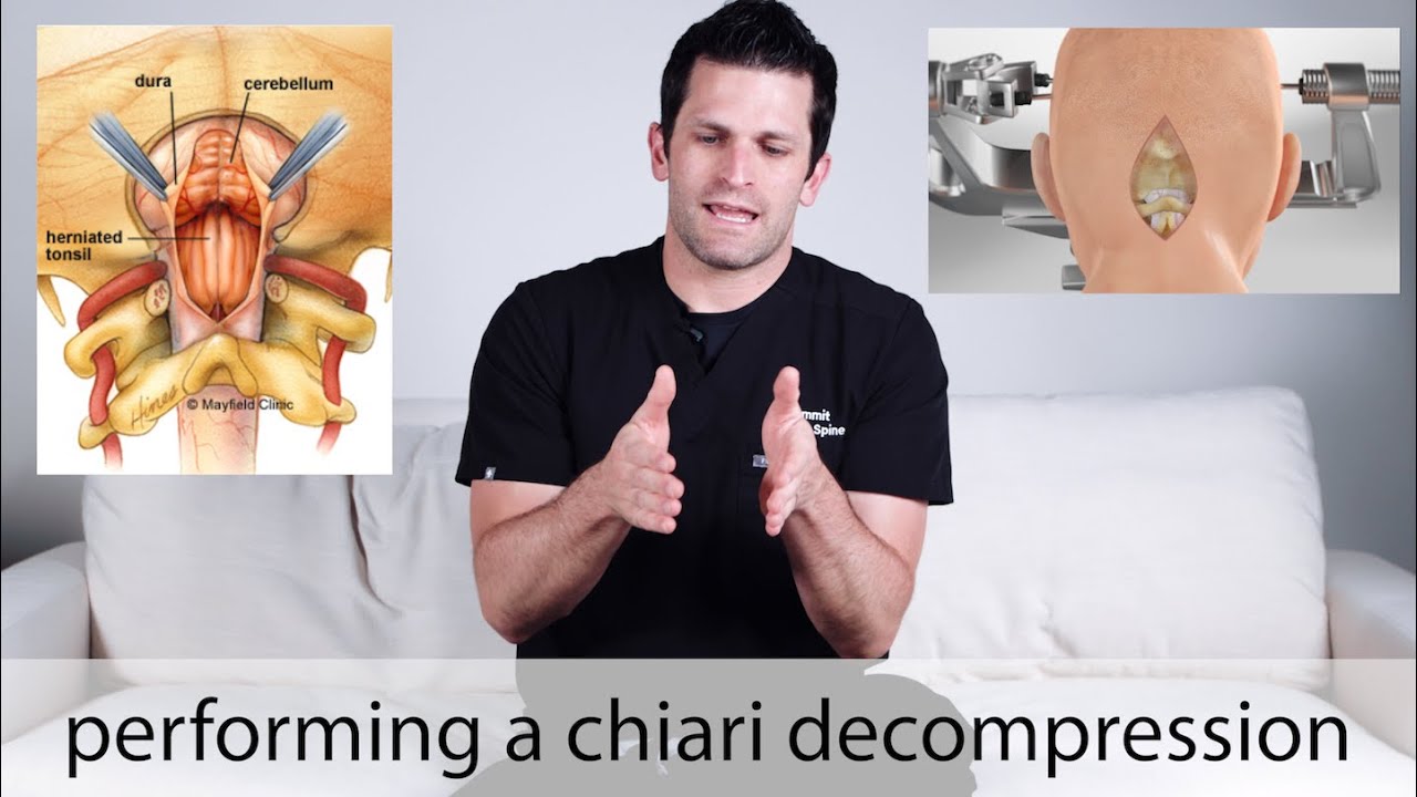 Chiari decompression surgery // how it's done