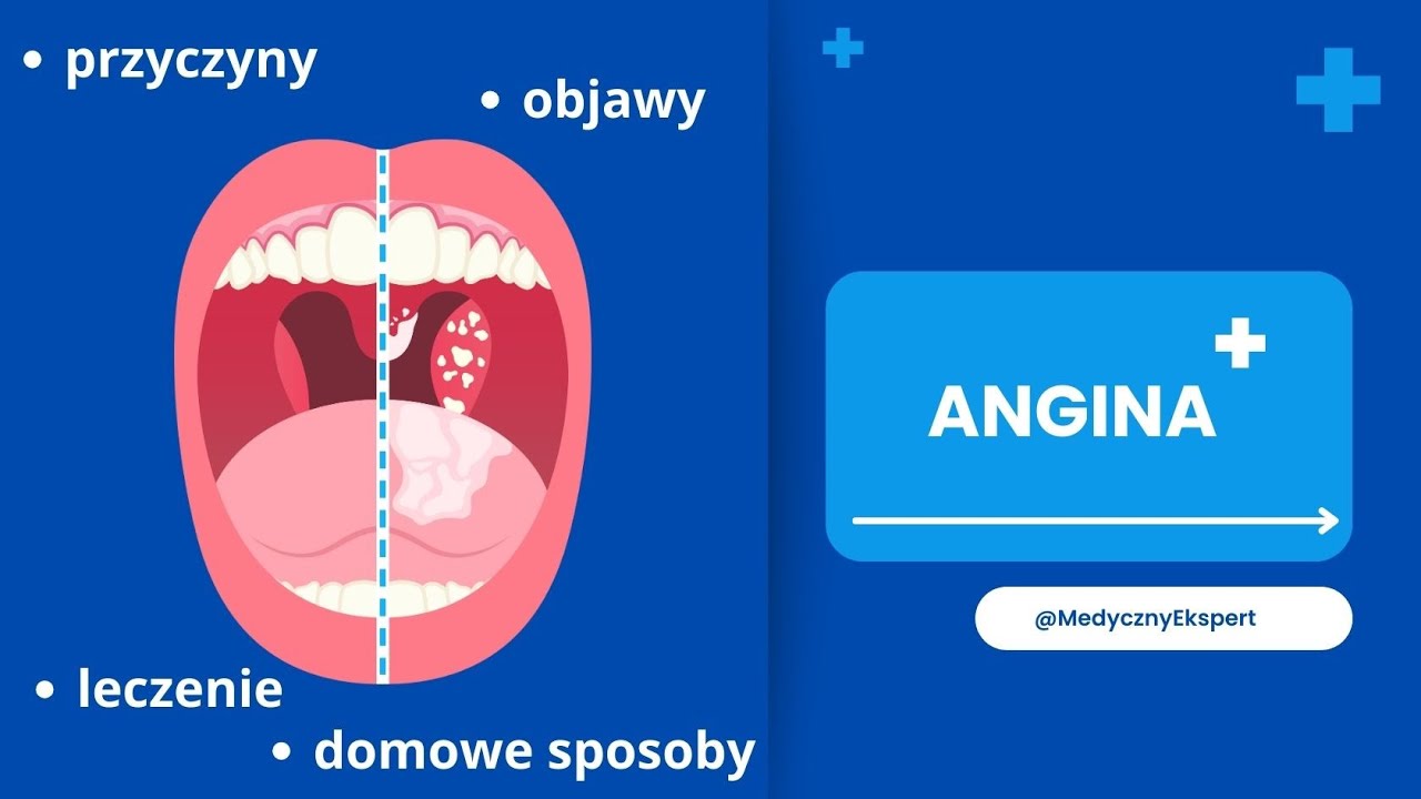 Angina - czym jest, przyczyny, objawy oraz proces leczenia