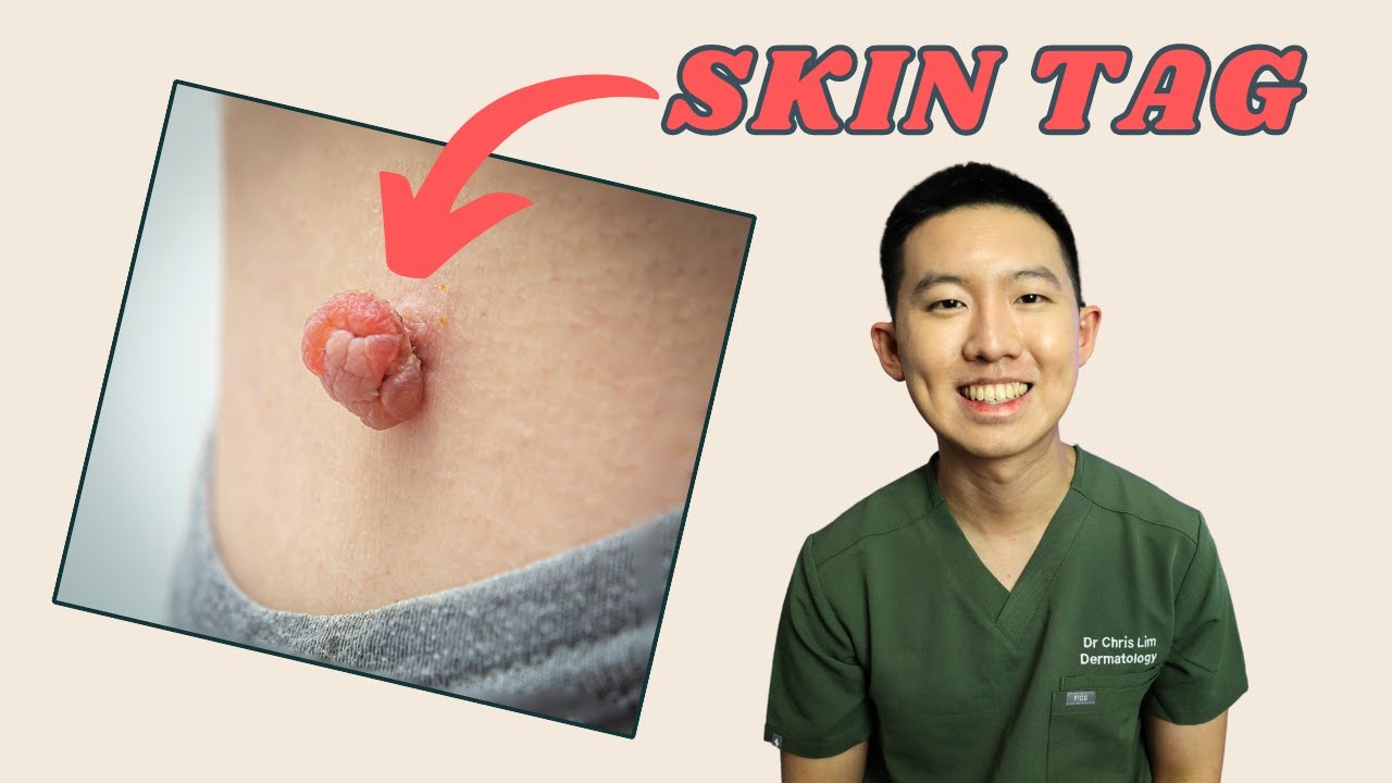 Thinking of removing a skin tag? Watch this first!