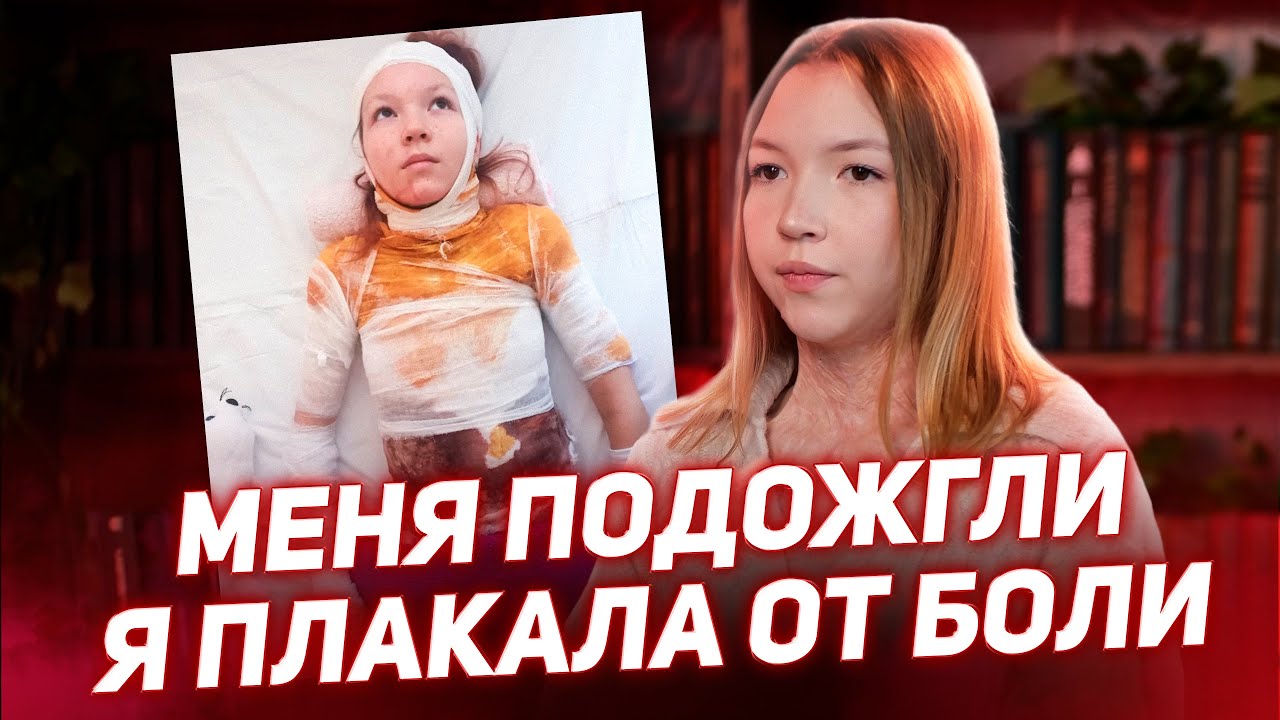 🔥 Меня ПОДОЖГЛИ подростки, спасла от ОГНЯ только ЛИЦО / История Киры Красновой