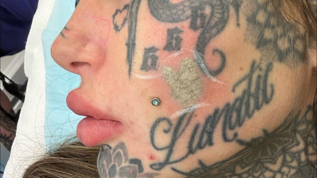 AMBER LUKE FACE TATTOO REMOVAL x 3 