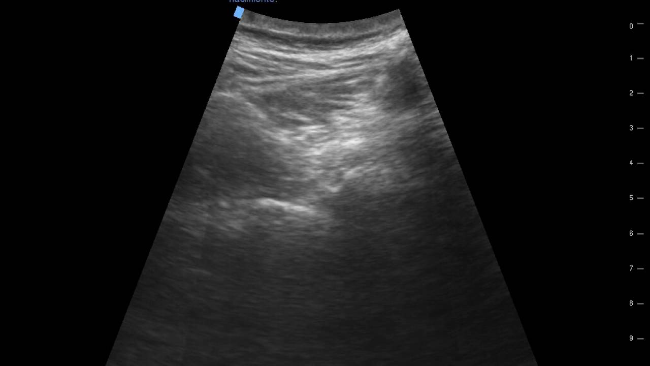 Bloqueo Radicular Lumbar Ecoguiado