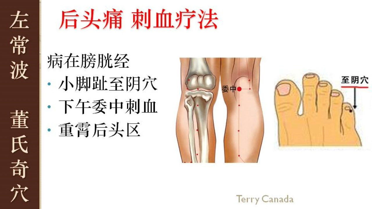 4.5 后头痛 刺血 |  左常波 董氏针灸 刺血 解结  | Master Tung Acupuncture Points