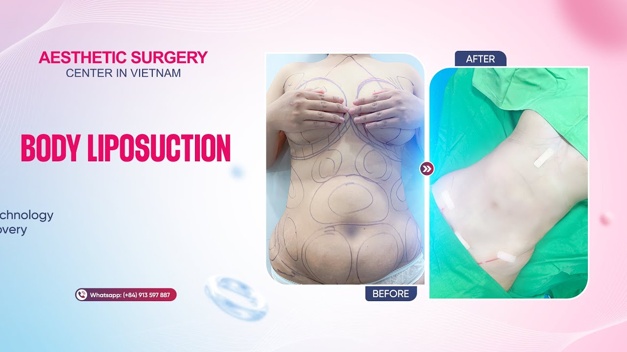 ADVANCED LIPOSUCTION TECHNOLOGY – SLIM BODY, FAST