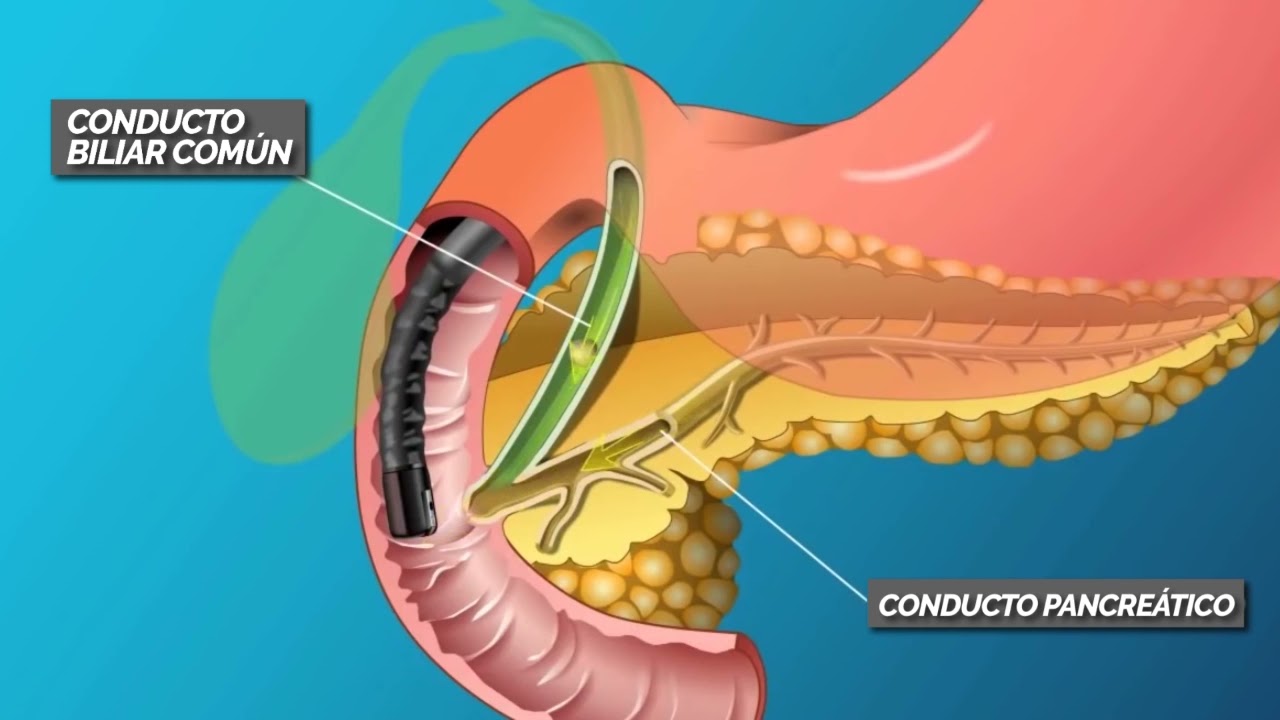 CPRE (COLANGIOPANCREATOGRAF&Iacute;A RETR&Oacute;GRADA ENDOSC&Oacute;PICA)