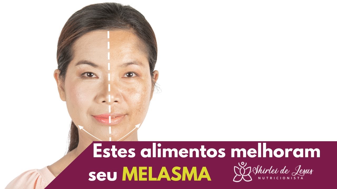 Como tratar o melasma pela alimentação│Shirlei de Jesus