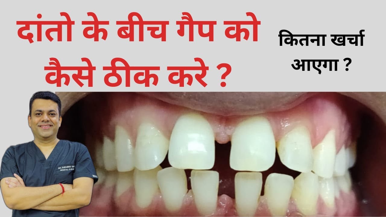 दांतो के बीच गैप को कैसे ठीक करे कितना खर्चा आएगा ? How to fix the gap between teeth