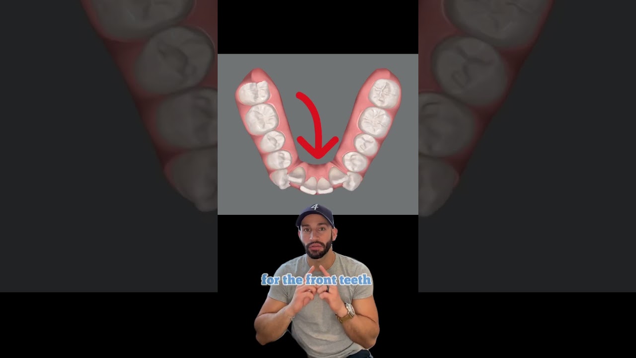 How does Invisalign work: A Case Review. 2023