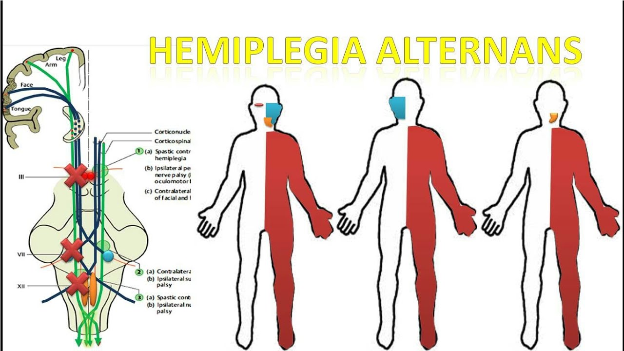Video 42 Hemiplegia Alternans