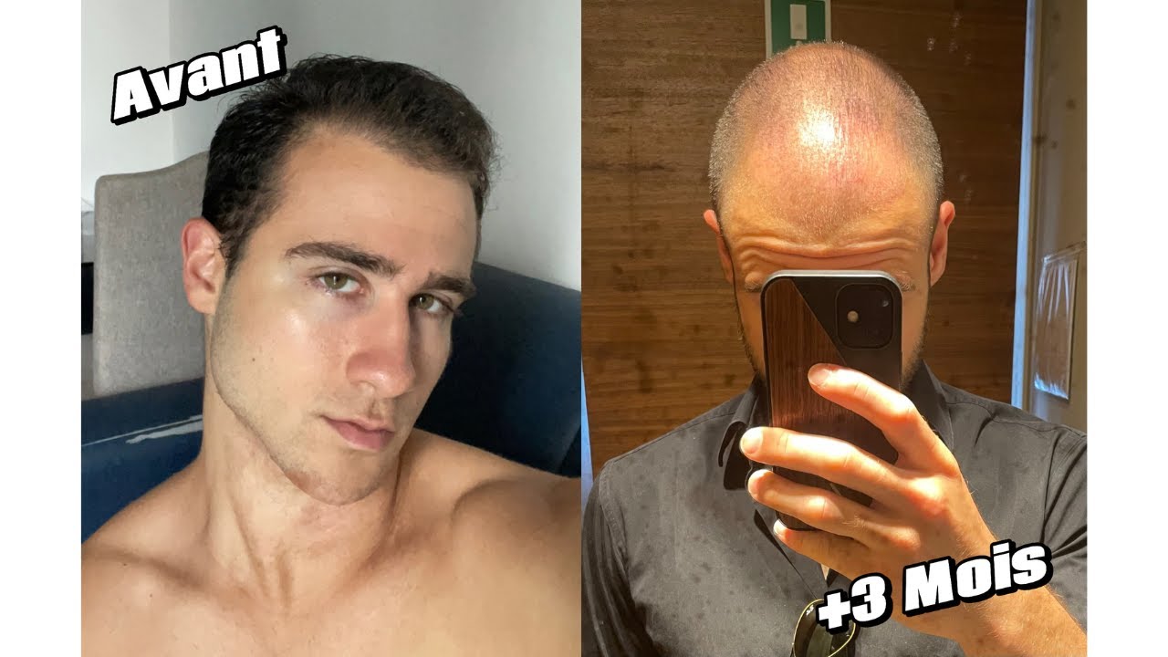 Ne Commence PAS le Minoxidil avant d'Avoir Vu cette Vidéo !