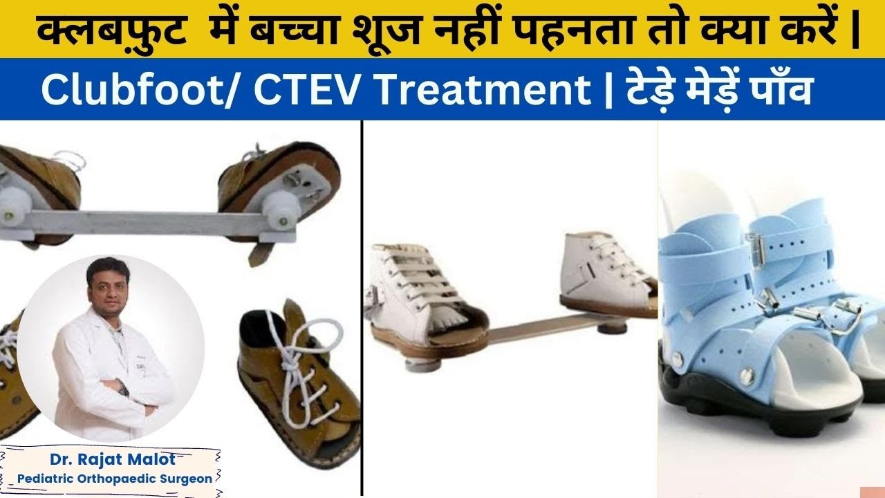 क्लबफ़ुट में बच्चा शूज नहीं पहनता तो क्या करें | Clubfoot/ CTEV treatment | टेड़े मेड़ें पाँव