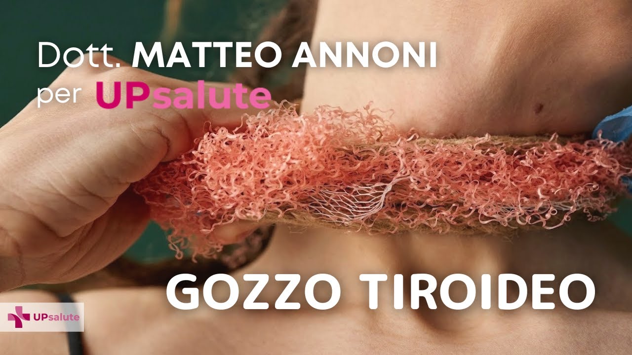 Gozzo - Dottor Matteo Annoni - UPsalute Channel