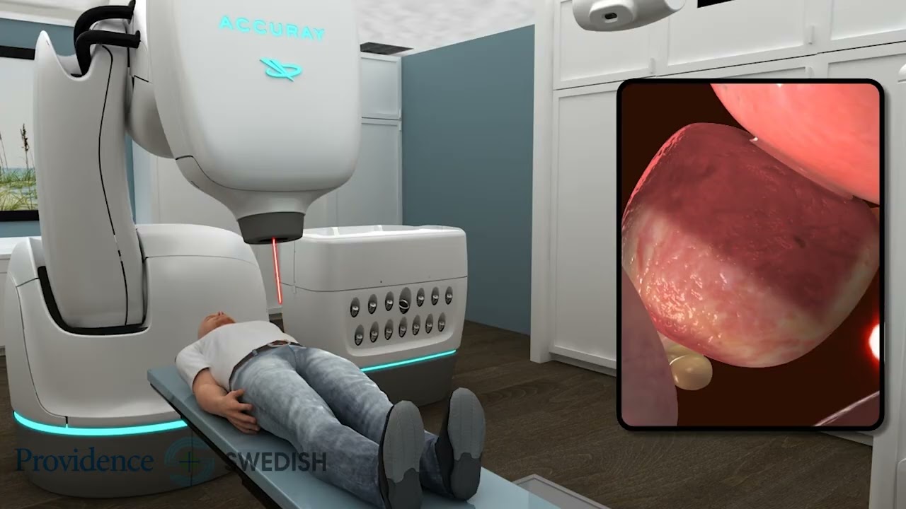 Dave Wyman - CyberKnife Prostate Treatment