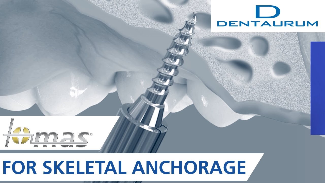 The tomas&reg; system for skeletal anchorage