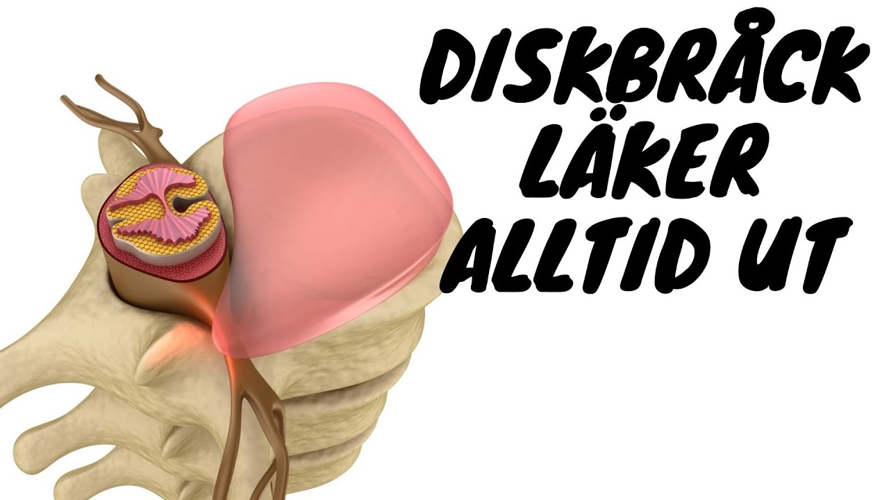 diskbråck läker alltid ut