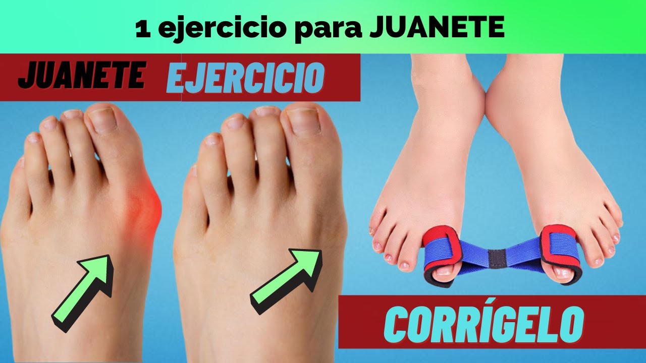 Corrige tu juanete con 1 ejercicio