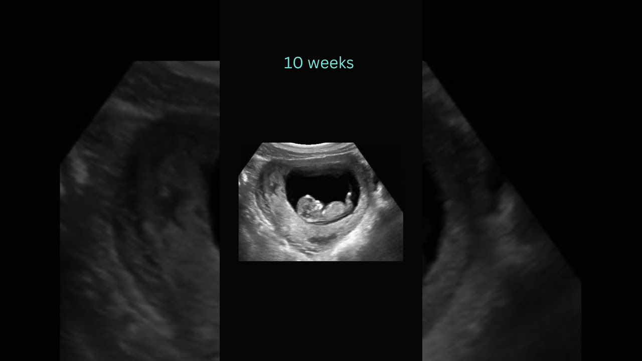 Sneak Peek: 10 Weeks Pregnancy Ultrasound! #baby #ultrasound #positivebirth #pregnant  #babyscan