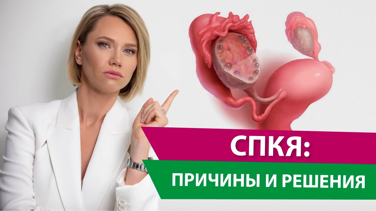 СПКЯ без гормонов: возможно ли? СПКЯ: симптомы и причины