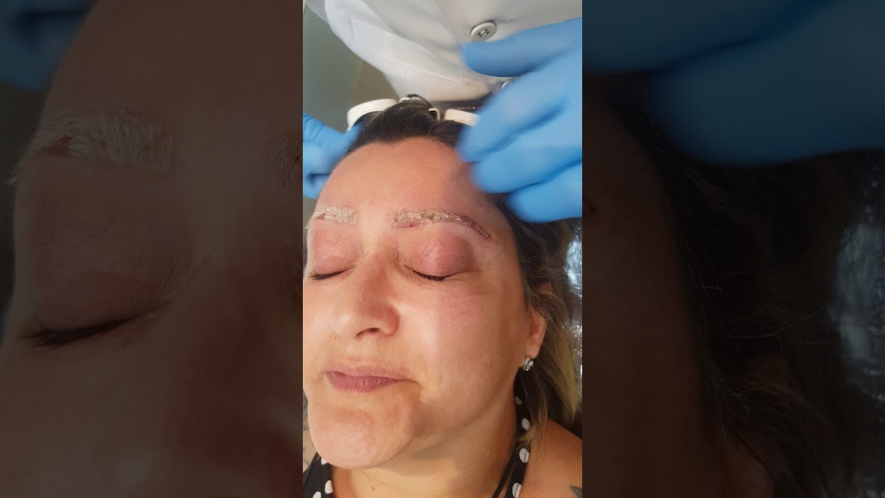 Remoção de Maquiagem Definitiva a Laser