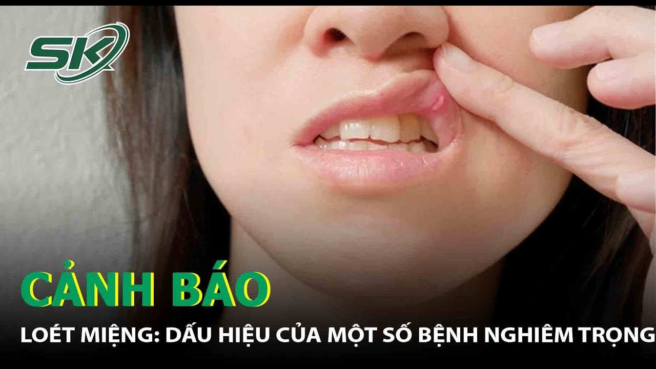 Loét Miệng, Nhiệt Miệng: Cảnh Giác Vì Có Thể Mắc Bệnh Nghiêm Trọng