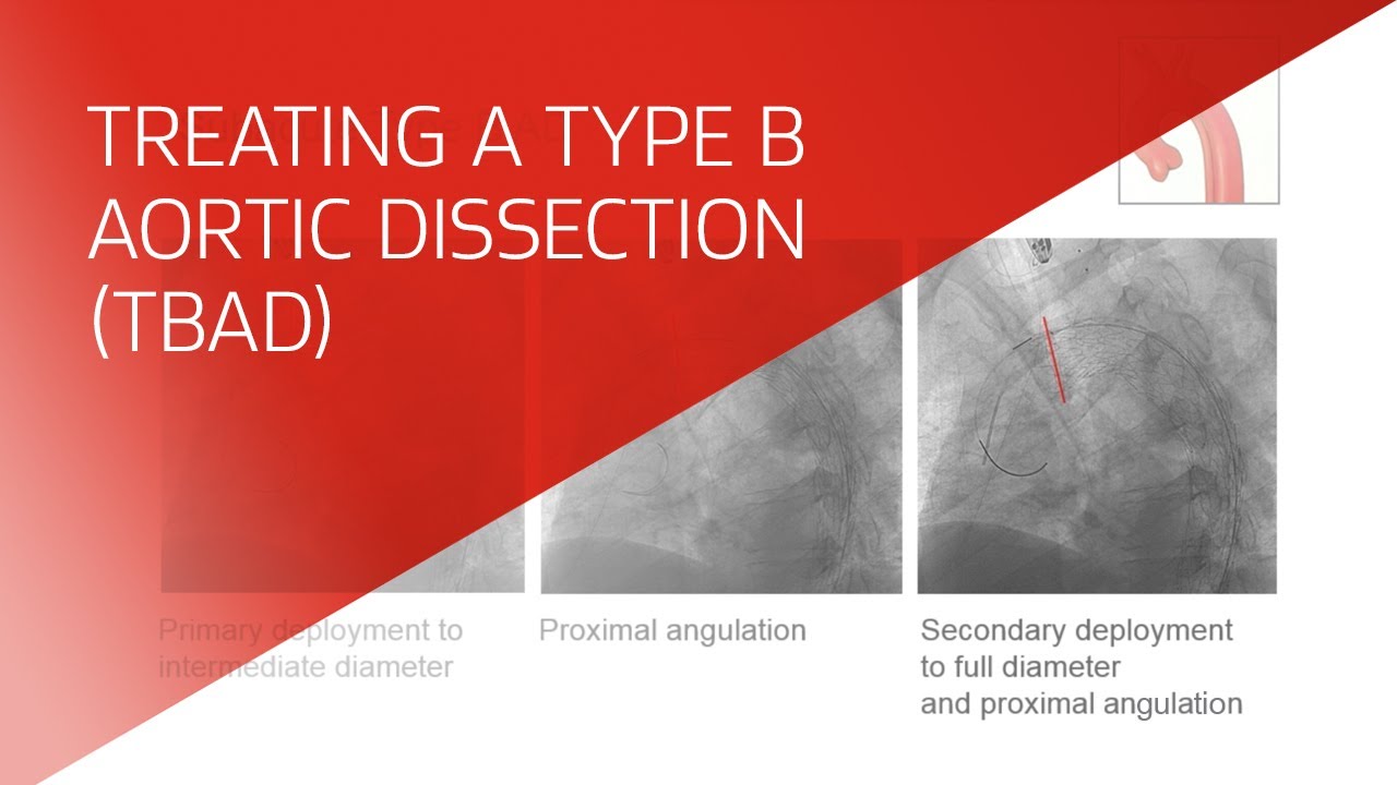 Type B aortic dissection (TBAD) case study