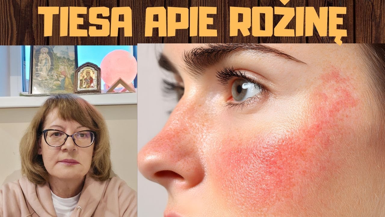 Rožinė: ar tai autoimuninė liga? Ką daryti