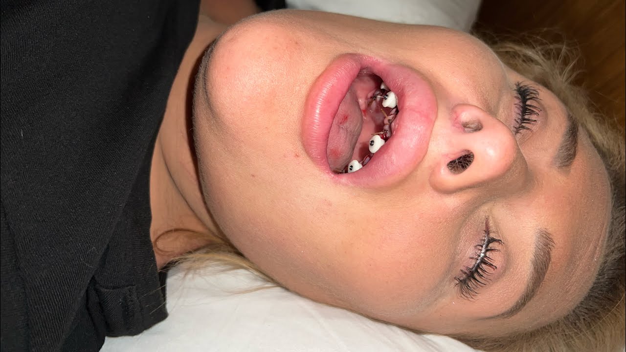 Done In One Vlog (Day 2 Extractions) Boca Raton, FL