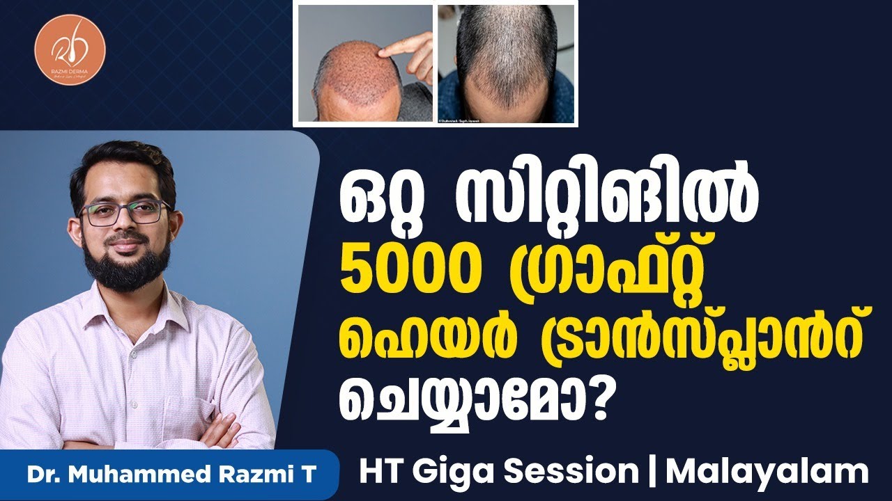 ഒറ്റ സിറ്റിങ്ങിൽ 5000 ഗ്രാഫ്റ്റ് ഹെയർ ട്രാൻസ്‌പ്ലാന്റ് ചെയ്യാമോ?HT Giga Session|Malayalam|Dr Razmi