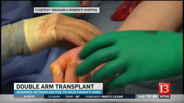Double arm transplant