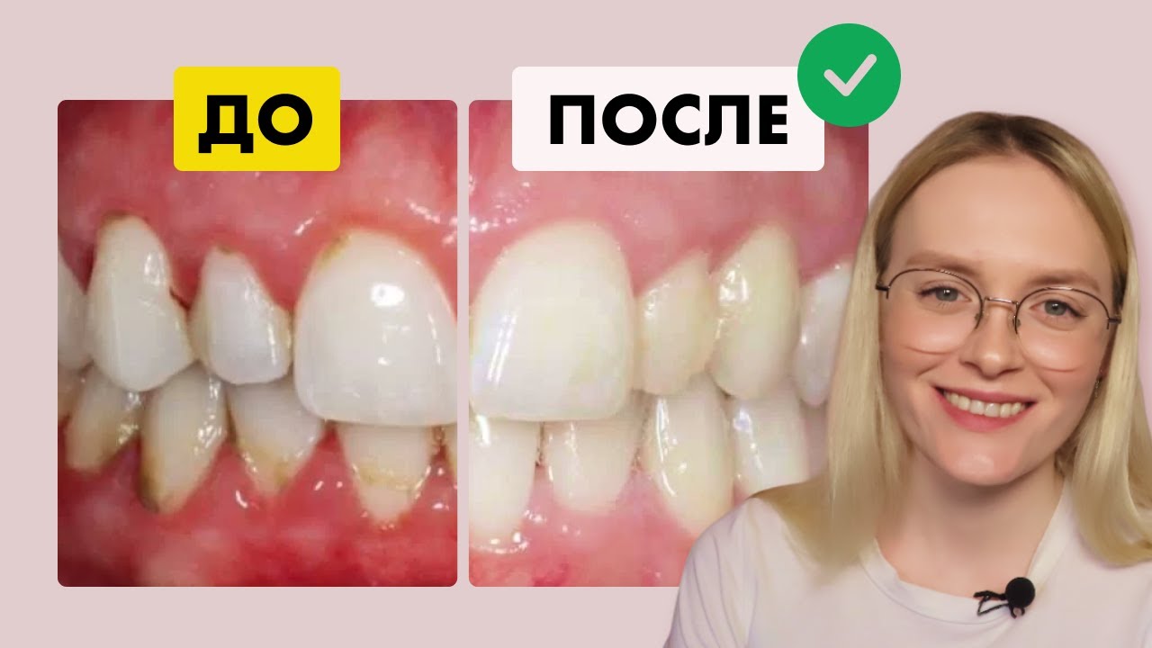 ТОП 10 способов как СНЯТЬ ВОСПАЛЕНИЕ и убрать отек десны в домашних условиях