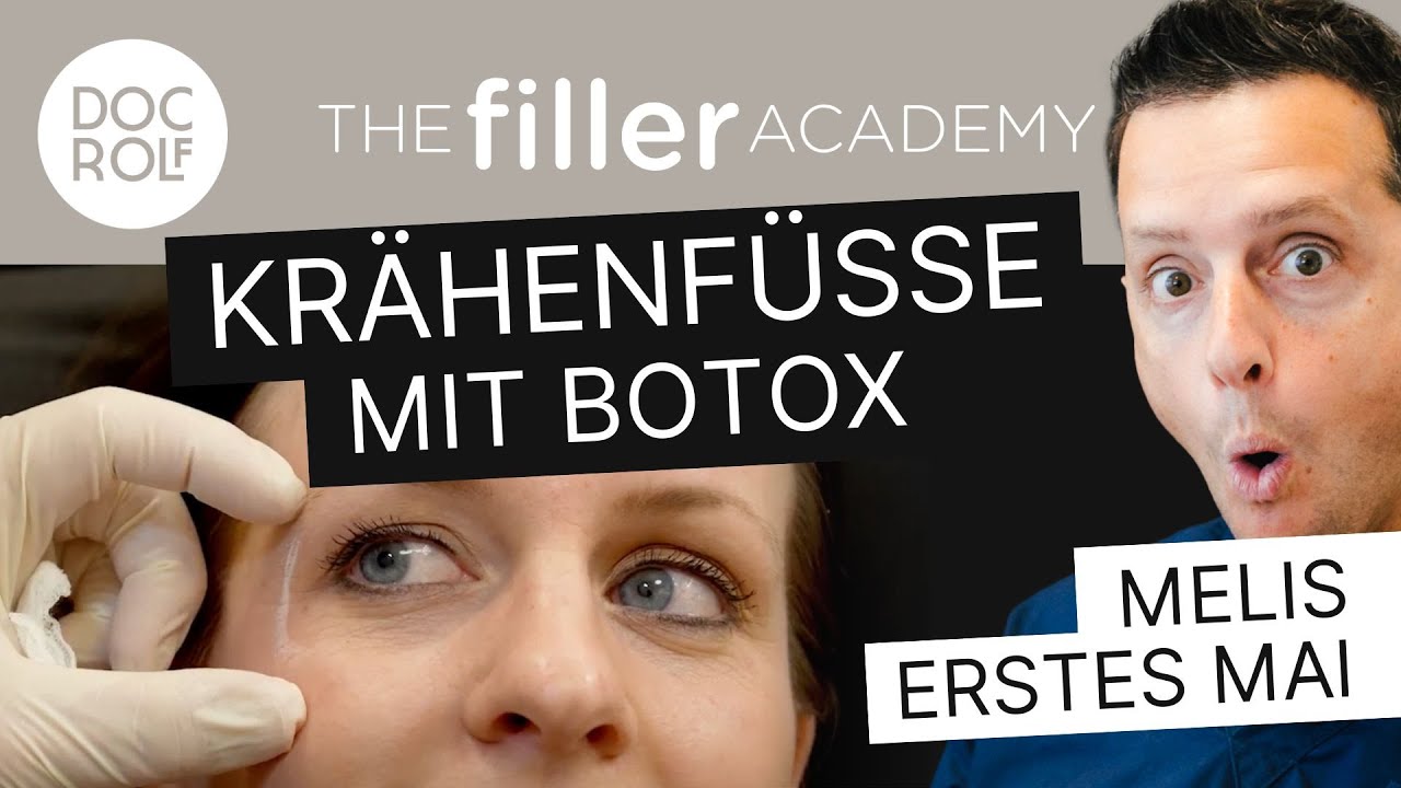 BOTOX KRÄHENFÜSSE INJEKTIONSPUNKTE  – TFA by Dr. Rolf Bartsch