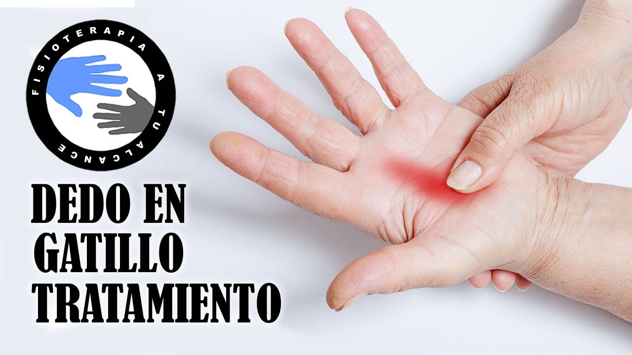 Dedo en gatillo o resorte, fisioterapia, tratamiento y ejercicios