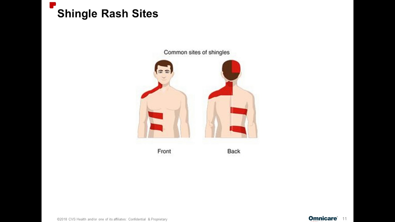 Webinar | Shingles: Do you know what signs to look for?