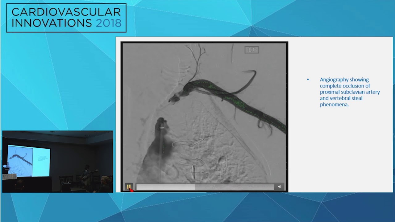 CVI2018 Coronary Challenging Case Competition: Semifinals 1 - Zain Ul Abideen Asad, MD