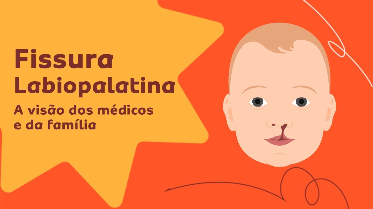 Fissura Labiopalatina: A Importância do Tratamento Multidisciplinar