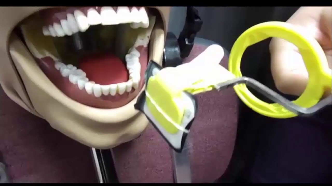 Posterior Periapical Mandibular Placement