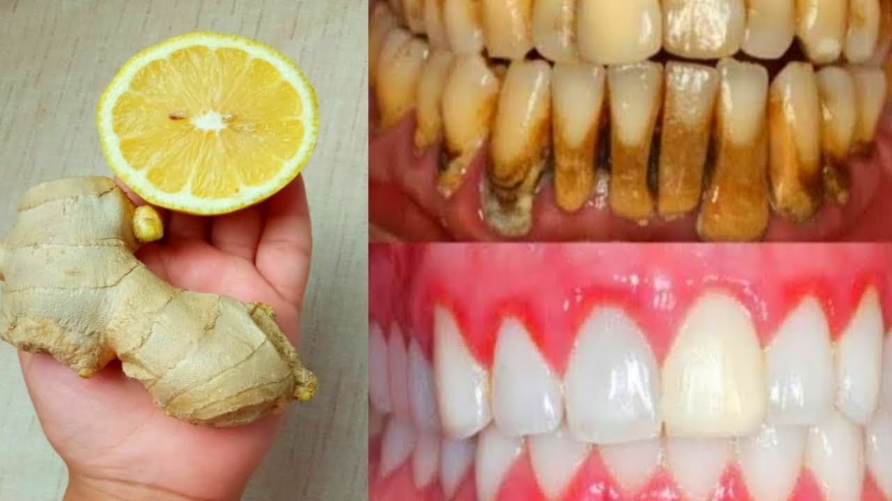 Blanchiment des dents &agrave; la maison avec quatre ingr&eacute;dients naturels d&egrave;s la premi&egrave;re semaine