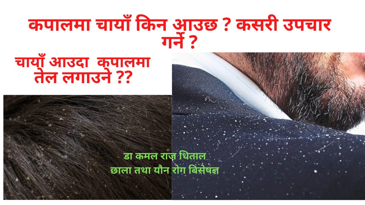 कपालमा आउने चायाँ के हो ?kapal ko chaya hatuane tarika , kasari hataune | dandruff removal in nepali