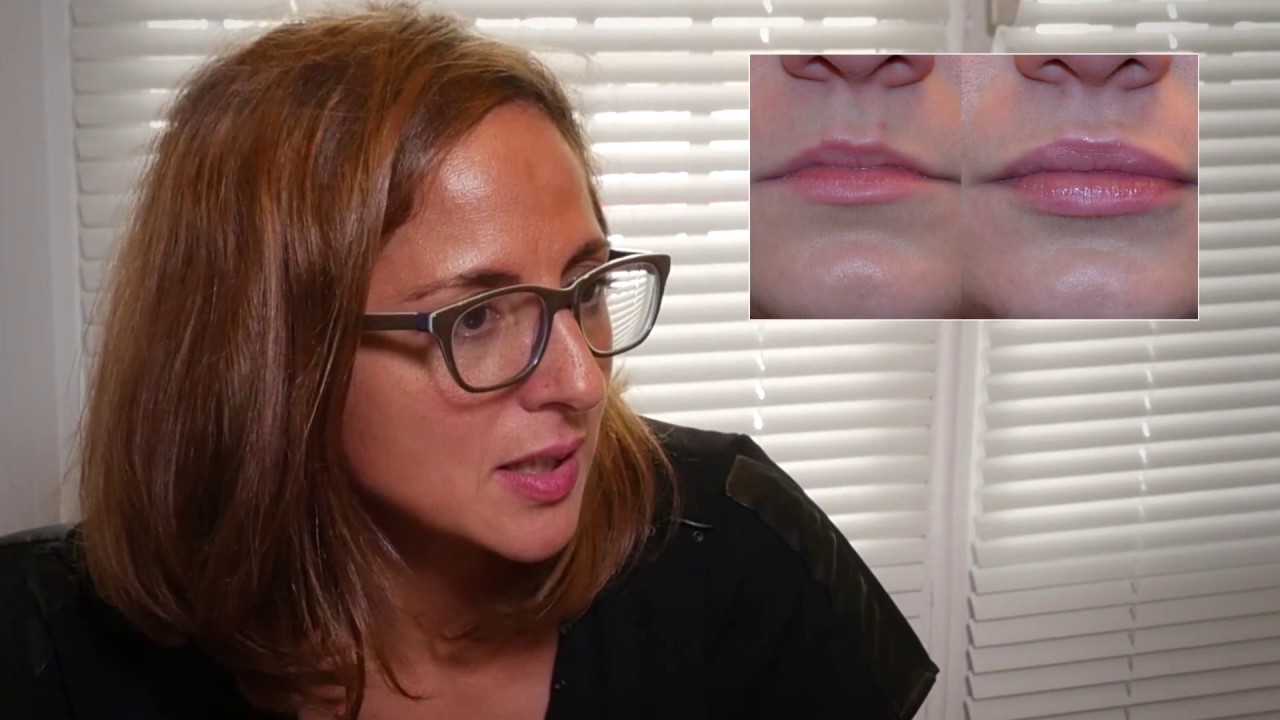L&rsquo;augmentation des l&egrave;vres au naturel &ndash; Dr Delphine Haddad