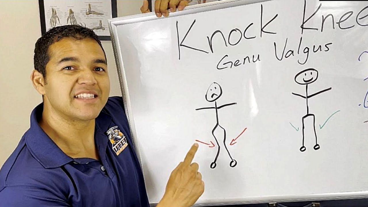Все, что вам нужно знать о Knock Knees