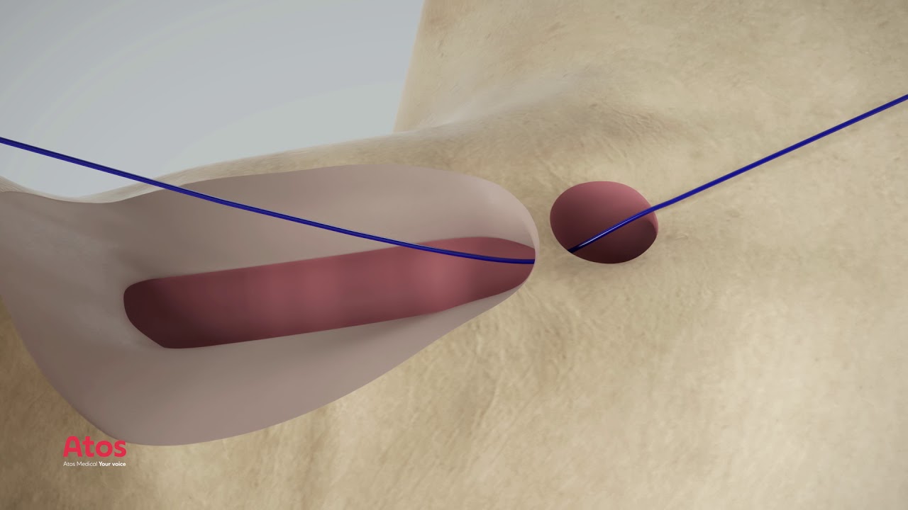 Provox Vega Puncture Set: Primary Puncture and Prosthesis Placement
