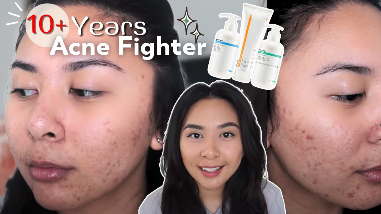 Battling Acne for 12 years: ACNE.ORG Skin Journey | Week 1 Day 1