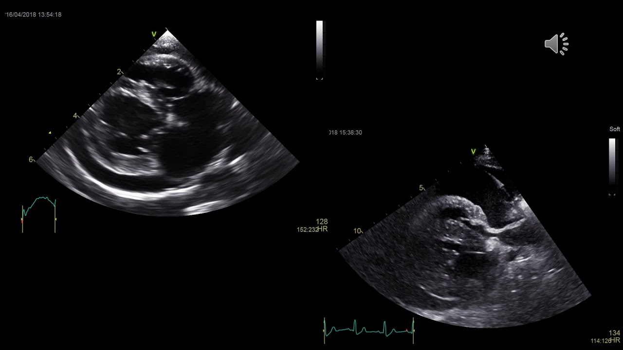 How to treat pericardial effusion