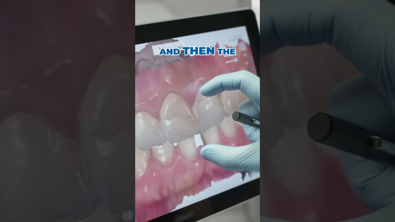 Dental Implants in Izmir: Steps You Can't Miss Out!