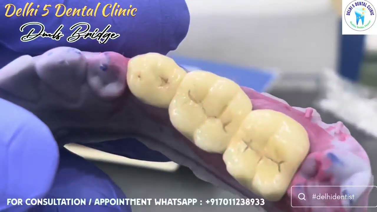 🚨Unboxing Premium DMLS Crown with 7 Year Warranty! 💯 | Delhi 5 Dental Clinic ​⁠@BeingDental