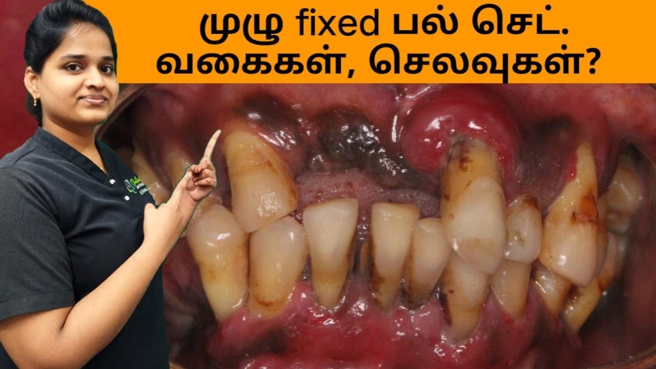 இம்பிளாண்ட் மூலம்  முழு  பல் செட் (fixed ஆக) !   பல் செட்  வகைகளும்? செலவுகளும்? - விளக்கங்கள்.