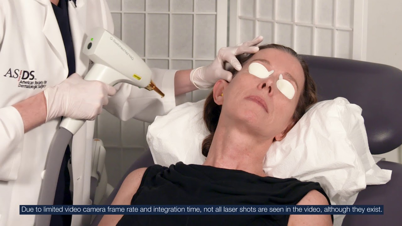 Lumenis M22 Q-Switched Patient Treatment #1 | Lumenis